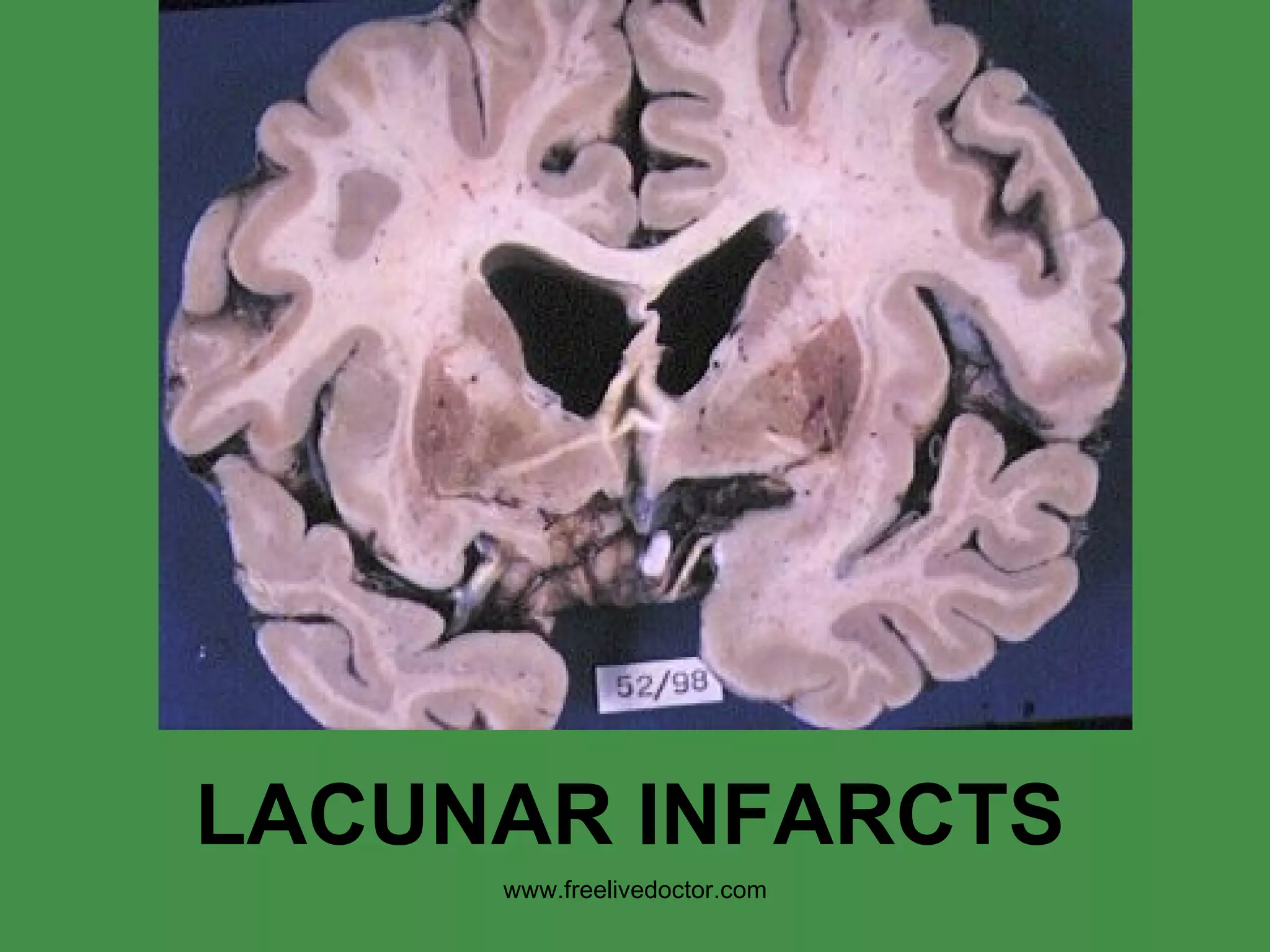 LACUNAR INFARCTS www.freelivedoctor.com 