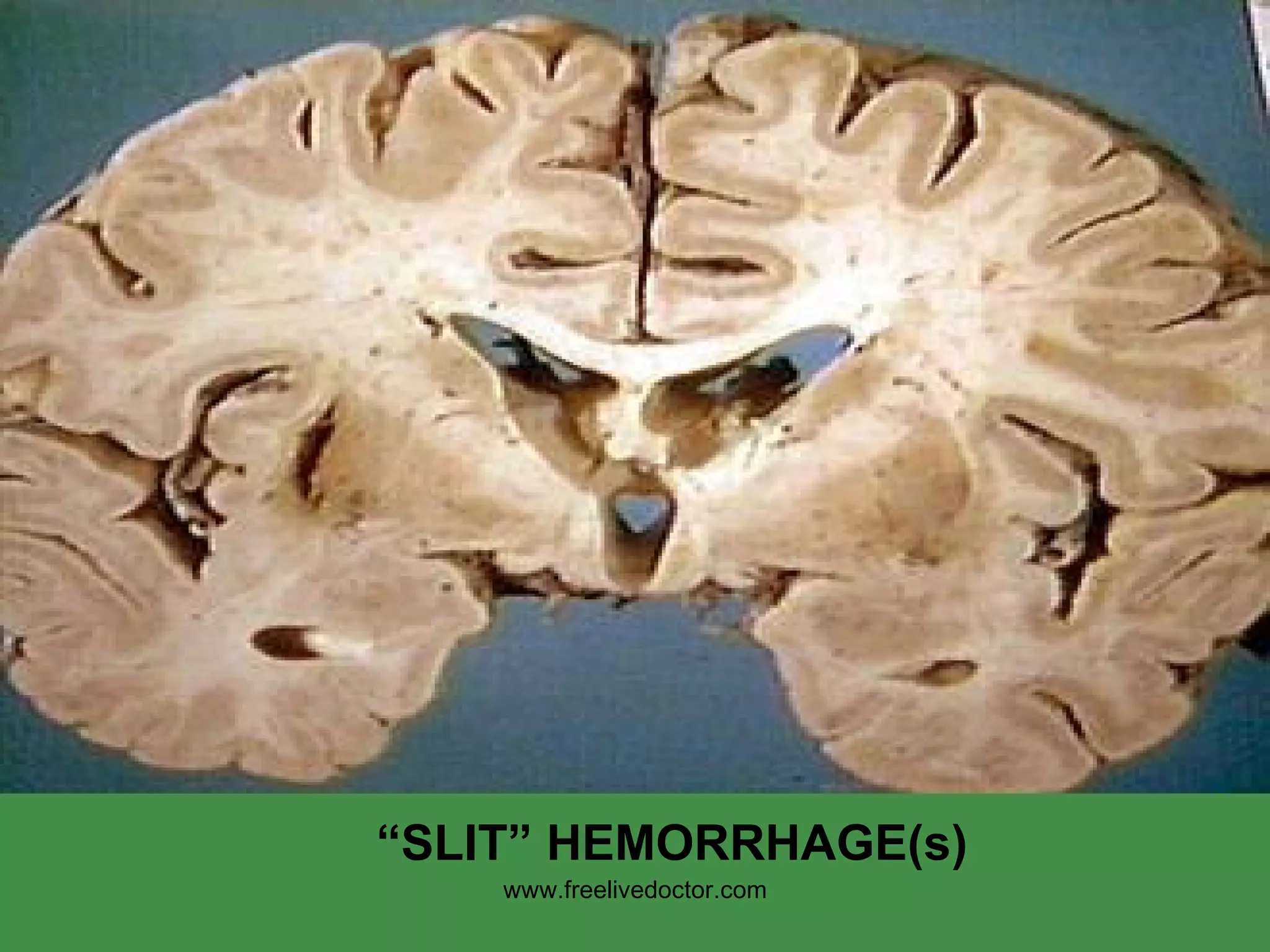 “ SLIT” HEMORRHAGE(s) www.freelivedoctor.com 
