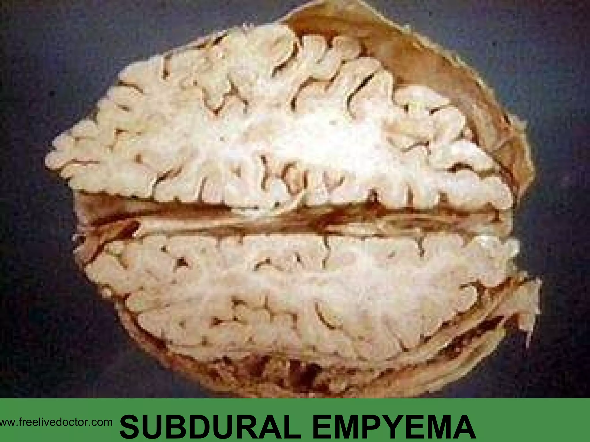 SUBDURAL EMPYEMA www.freelivedoctor.com 
