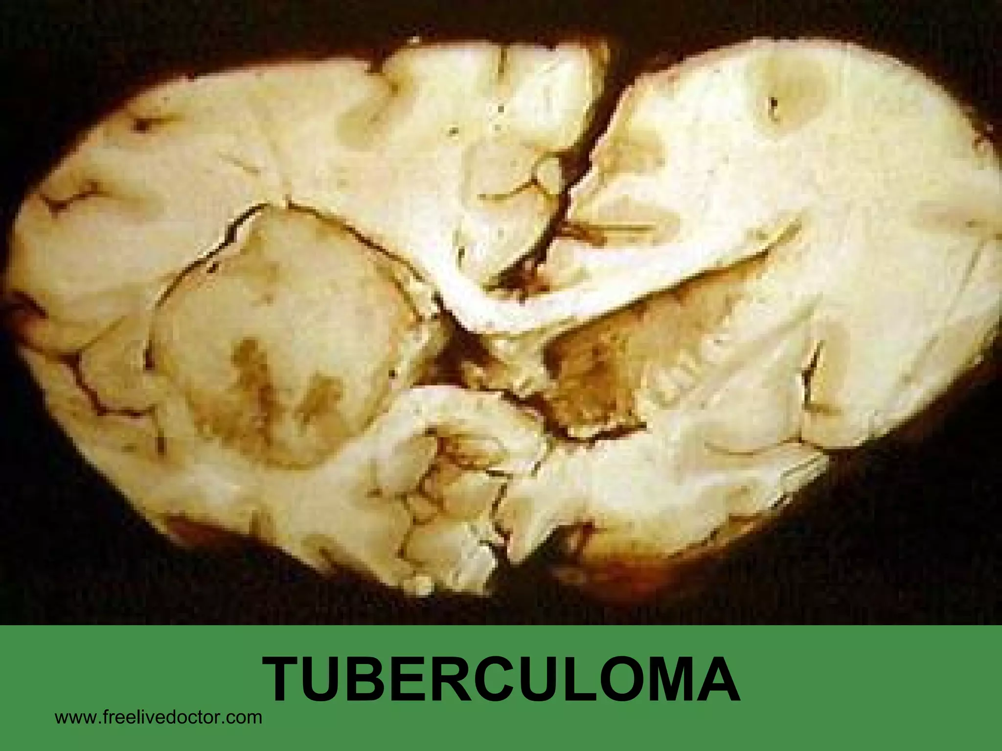 TUBERCULOMA www.freelivedoctor.com 
