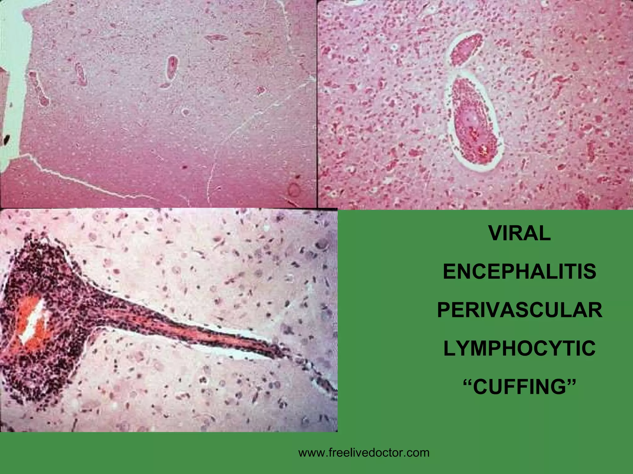 VIRAL ENCEPHALITIS PERIVASCULAR LYMPHOCYTIC “ CUFFING” www.freelivedoctor.com 
