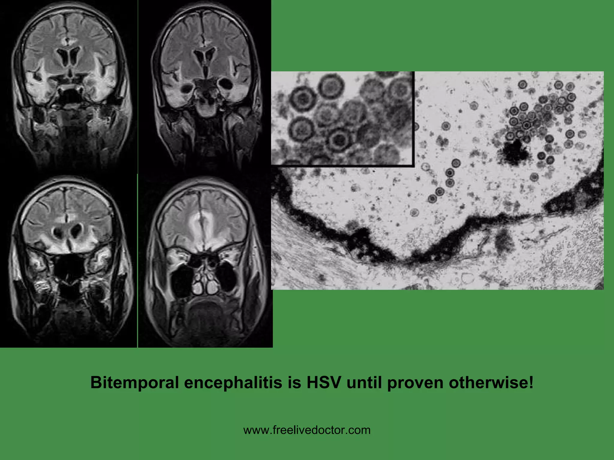 Bitemporal encephalitis is HSV until proven otherwise! www.freelivedoctor.com 