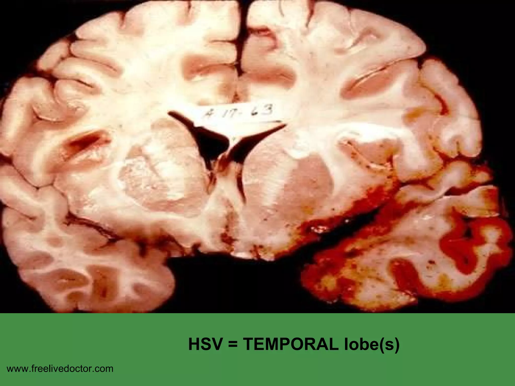 HSV = TEMPORAL lobe(s) www.freelivedoctor.com 