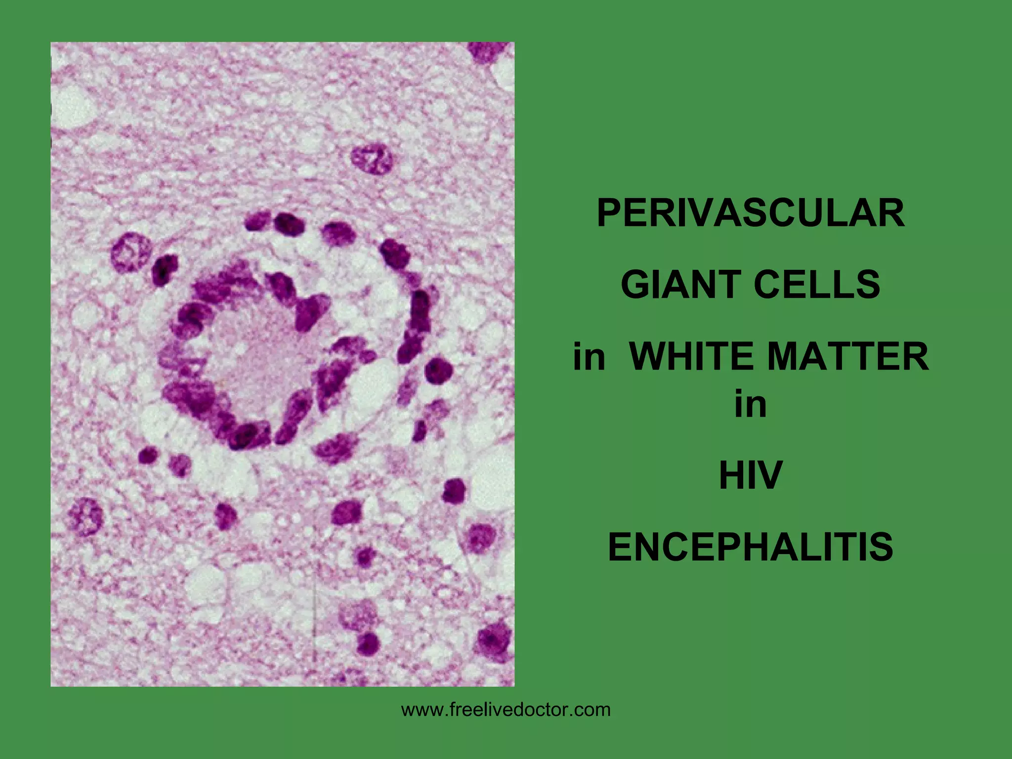 PERIVASCULAR GIANT CELLS in  WHITE MATTER in HIV ENCEPHALITIS www.freelivedoctor.com 