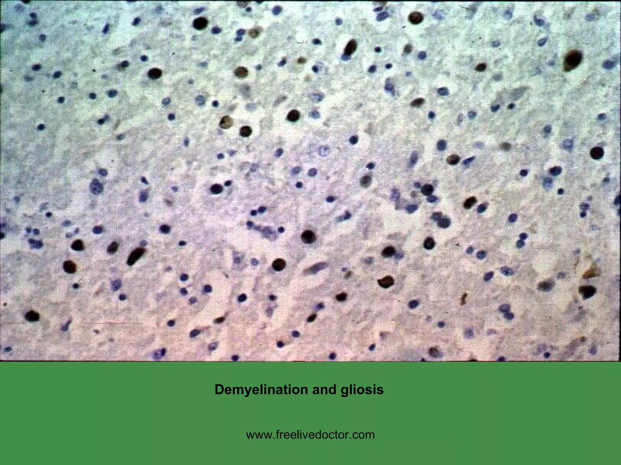 www.freelivedoctor.com Demyelination and gliosis 