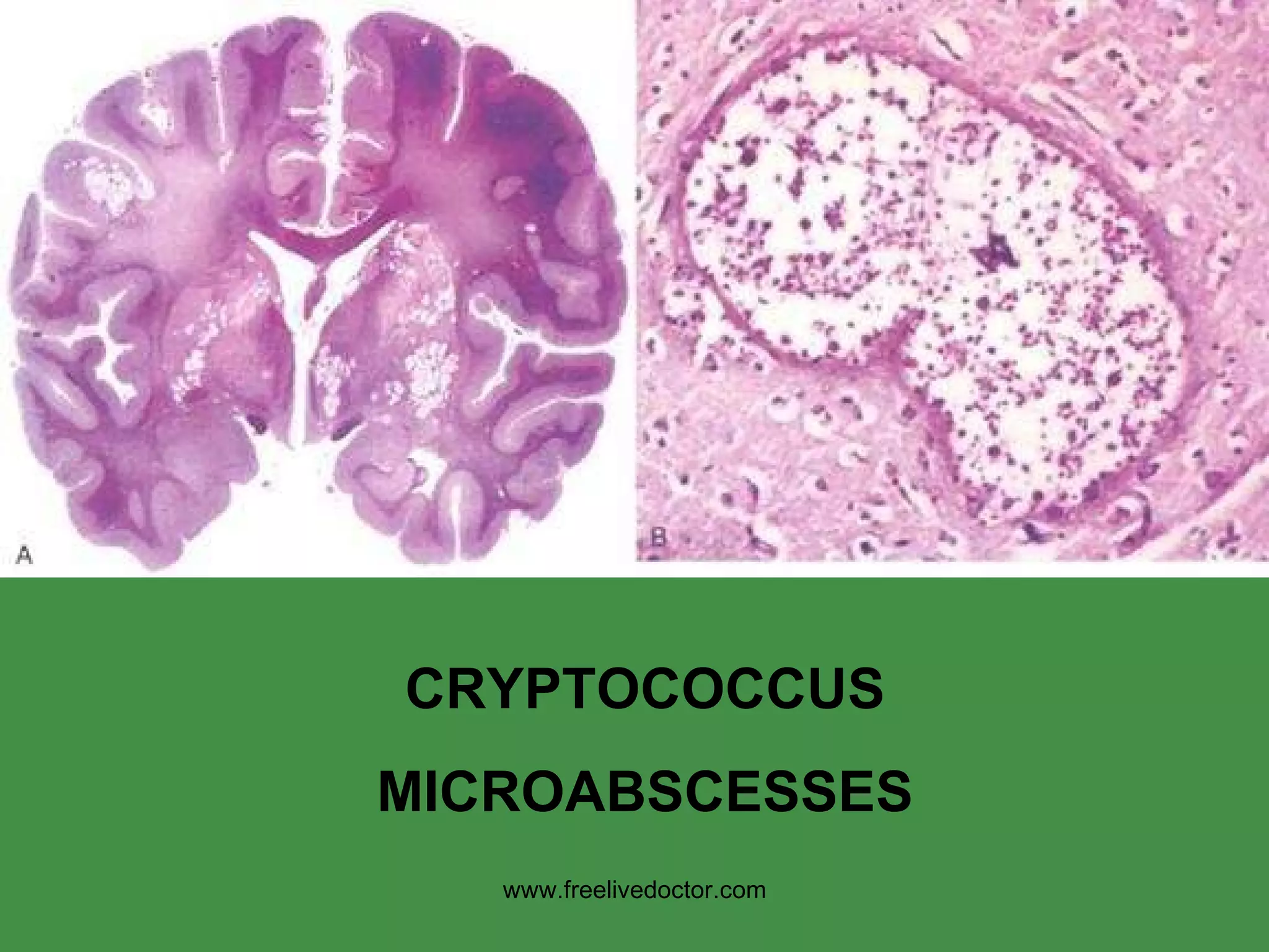 CRYPTOCOCCUS MICROABSCESSES www.freelivedoctor.com 