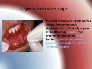 Gingival Diseases of Viral Origin:


                 the most common being the herpes
                 viruses-Primary herpetic
                 gingivostomatitis Clinically appear
                 as: Multiple tiny vesicles that
                 progress to form painful ulcers.
                 Painful erythematous swollen
                 gingival. Fever, malaise, cervical
                 lymphadenopathy.
 
