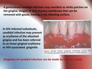 A generalized candidal infection may manifest as white patches on
the gingiva, tongue or oral mucous membrane that can be
removed with gauze, leaving a red, bleeding surface.



In HIV-infected individuals,
candidal infection may present
as erythema of the attached
gingiva and has been referred
to as linear gingival erythema
or HIV-associated gingivitis


Diagnosis of candidal infection can be made by culture, smear.
 