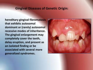 Gingival Diseases of Genetic Origin:


hereditary gingival fibromatosis
that exhibits autosomal
dominant or (rarely) autosomal
recessive modes of inheritance.
The gingival enlargement may
completely cover the teeth,
delay eruption, and present as
an isolated finding or be
associated with several more
generalized syndromes.
 