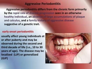 Aggressive Periodontitis
   Aggressive periodontitis differs from the chronic form primarily
  by the rapid rate of disease progression seen in an otherwise
  healthy individual, an absence of large accumulations of plaque
  and calculus, and a family history of aggressive disease
  suggestive of a genetic trait.

early onset periodontitis
usually affect young individuals at
or after puberty and may be
observed during the second and
third decade of life (i.e., 10 to 30
years of age). The disease may be
localized (LJP) or generalized
(GJP)
 