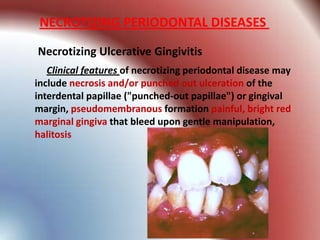 NECROTIZING PERIODONTAL DISEASES

Necrotizing Ulcerative Gingivitis
   Clinical features of necrotizing periodontal disease may
include necrosis and/or punched out ulceration of the
interdental papillae ("punched-out papillae") or gingival
margin, pseudomembranous formation painful, bright red
marginal gingiva that bleed upon gentle manipulation,
halitosis
 
