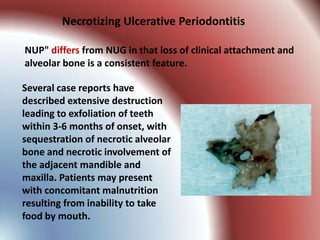 Necrotizing Ulcerative Periodontitis

NUP" differs from NUG in that loss of clinical attachment and
alveolar bone is a consistent feature.

Several case reports have
described extensive destruction
leading to exfoliation of teeth
within 3-6 months of onset, with
sequestration of necrotic alveolar
bone and necrotic involvement of
the adjacent mandible and
maxilla. Patients may present
with concomitant malnutrition
resulting from inability to take
food by mouth.
 