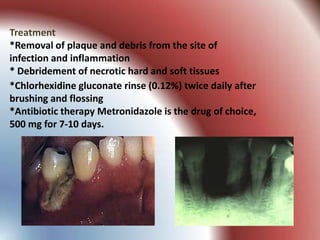 Treatment
*Removal of plaque and debris from the site of
infection and inflammation
* Debridement of necrotic hard and soft tissues
*Chlorhexidine gluconate rinse (0.12%) twice daily after
brushing and flossing
*Antibiotic therapy Metronidazole is the drug of choice,
500 mg for 7-10 days.
 