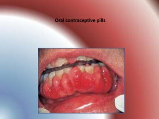 Oral contraceptive pills
 