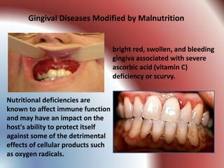 Gingival Diseases Modified by Malnutrition


                                    bright red, swollen, and bleeding
                                    gingiva associated with severe
                                    ascorbic acid (vitamin C)
                                    deficiency or scurvy.


Nutritional deficiencies are
known to affect immune function
and may have an impact on the
host's ability to protect itself
against some of the detrimental
effects of cellular products such
as oxygen radicals.
 