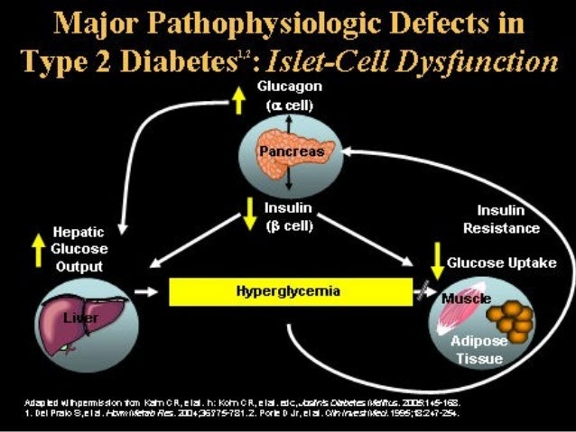 islet replacement for diabetes