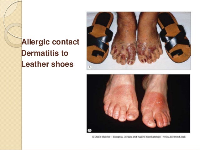 Classification of immune injuries or hypersenstivity reactions or imm…