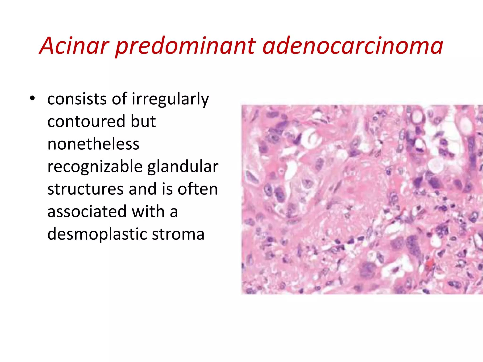 Acinar predominant adenocarcinoma
• consists of irregularly
contoured but
nonetheless
recognizable glandular
structures and is often
associated with a
desmoplastic stroma
 