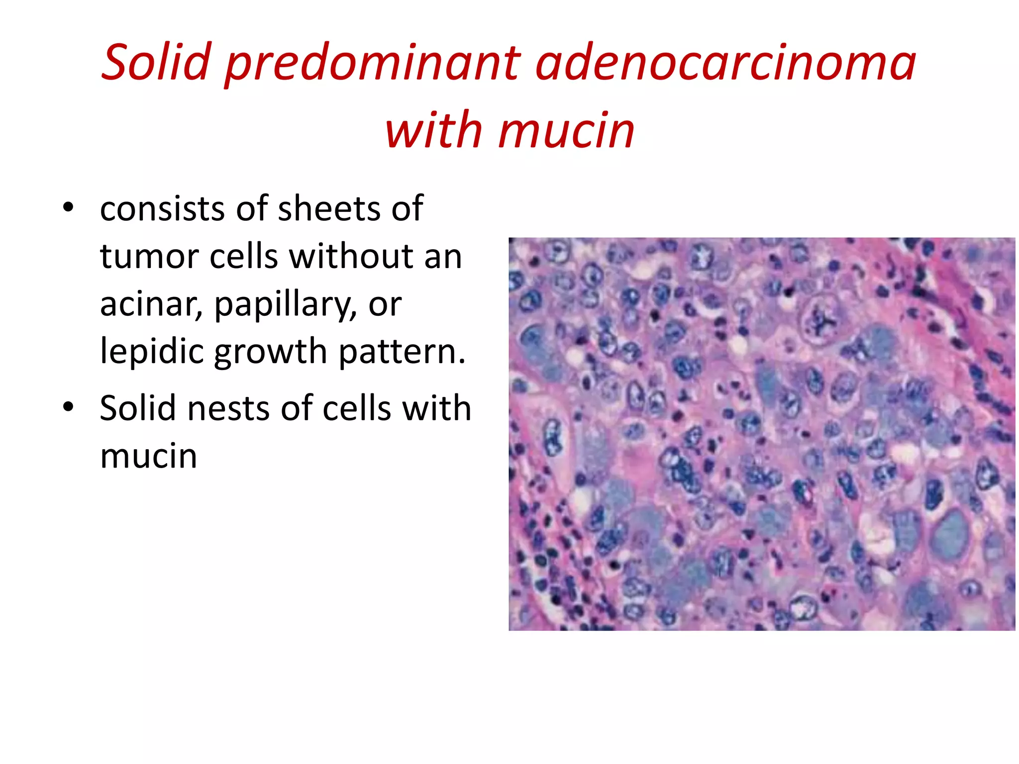 Solid predominant adenocarcinoma
with mucin
• consists of sheets of
tumor cells without an
acinar, papillary, or
lepidic growth pattern.
• Solid nests of cells with
mucin
 