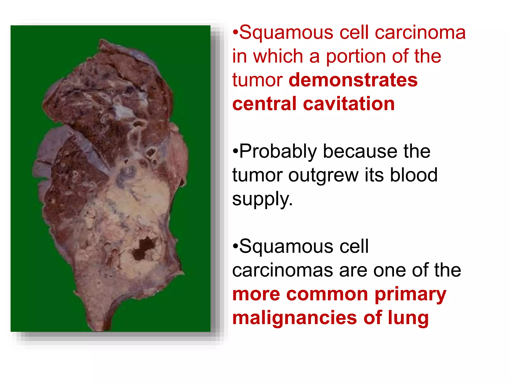 •Squamous cell carcinoma
in which a portion of the
tumor demonstrates
central cavitation
•Probably because the
tumor outgrew its blood
supply.
•Squamous cell
carcinomas are one of the
more common primary
malignancies of lung
 
