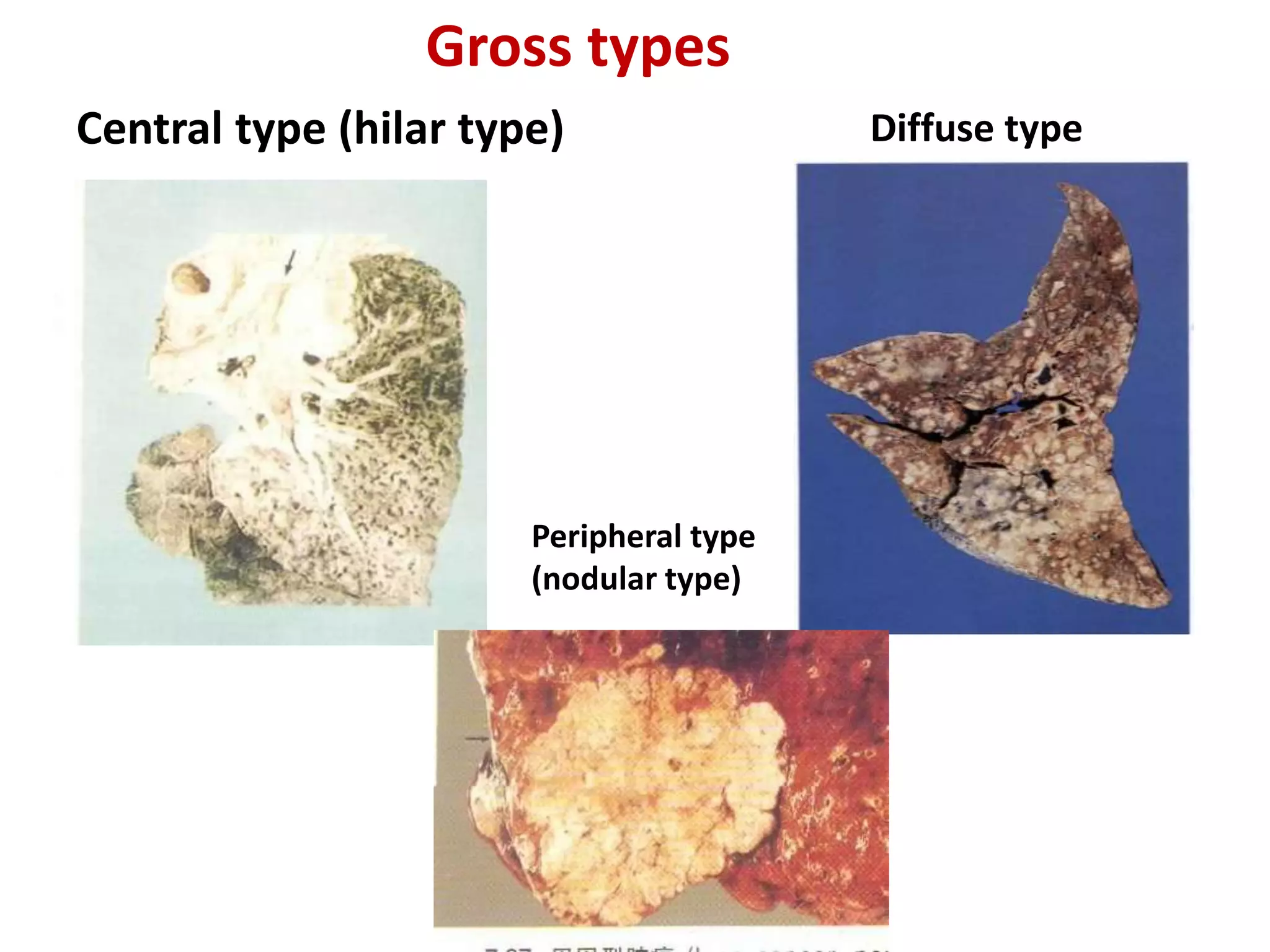 Central type (hilar type) Diffuse type
Peripheral type
(nodular type)
Gross types
 