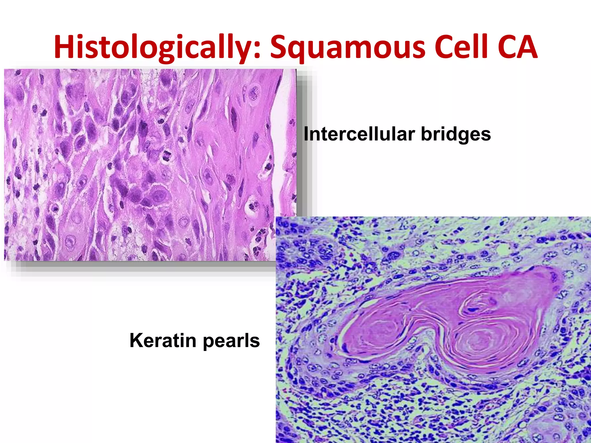 Histologically: Squamous Cell CA
Keratin pearls
Intercellular bridges
 