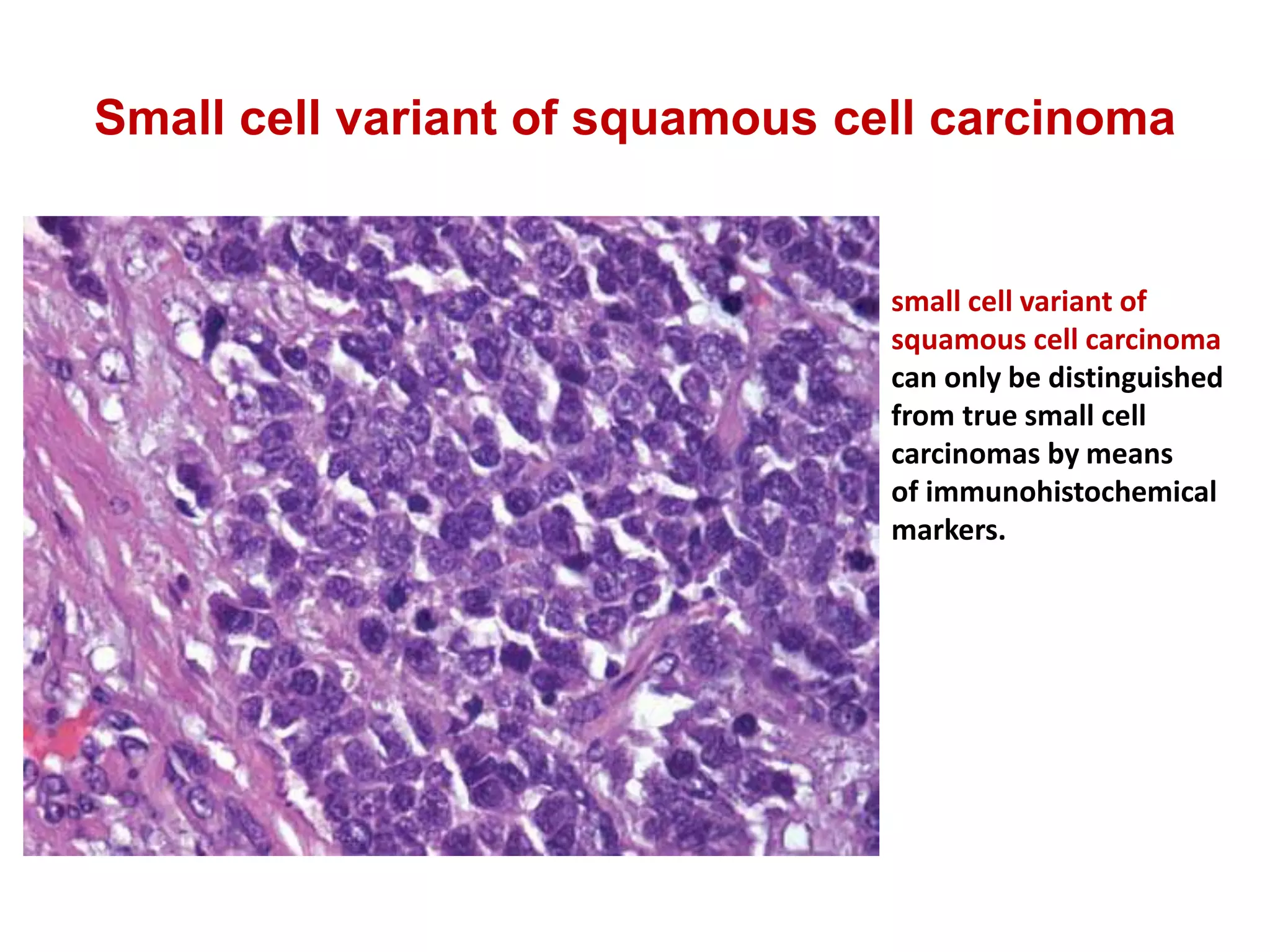Small cell variant of squamous cell carcinoma
small cell variant of
squamous cell carcinoma
can only be distinguished
from true small cell
carcinomas by means
of immunohistochemical
markers.
 