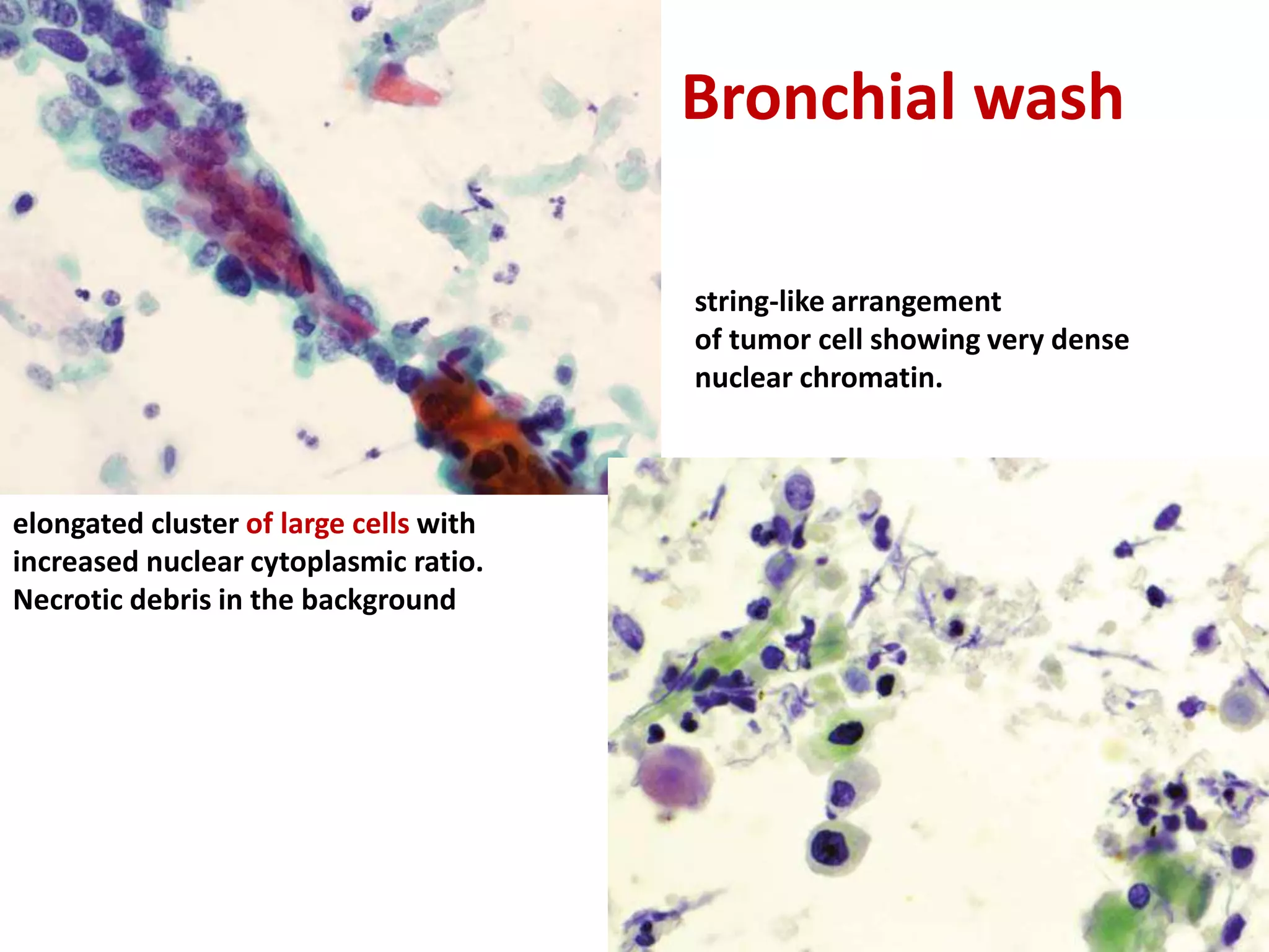 Bronchial wash
elongated cluster of large cells with
increased nuclear cytoplasmic ratio.
Necrotic debris in the background
string-like arrangement
of tumor cell showing very dense
nuclear chromatin.
 