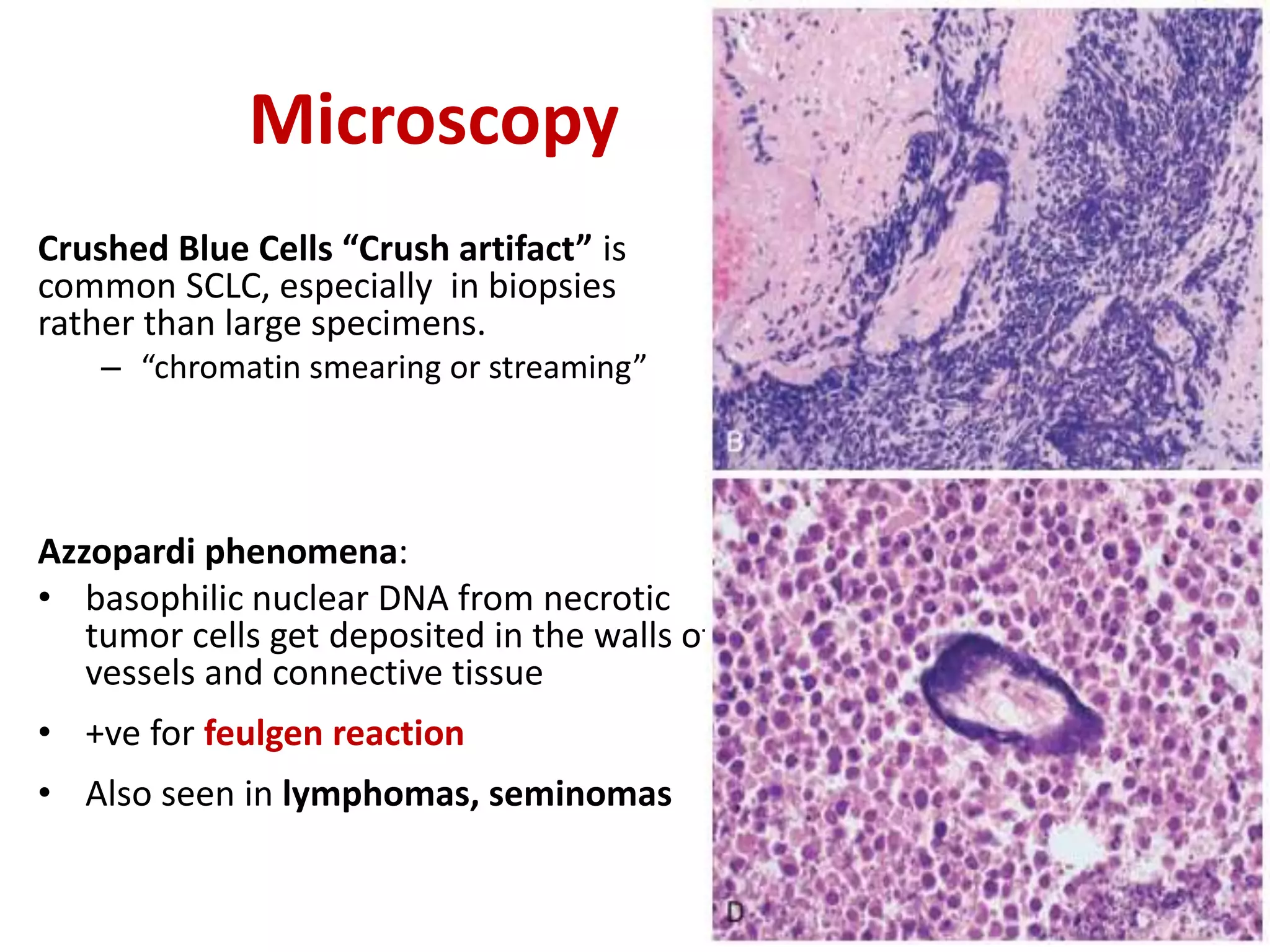 Microscopy
Crushed Blue Cells “Crush artifact” is
common SCLC, especially in biopsies
rather than large specimens.
– “chromatin smearing or streaming”
Azzopardi phenomena:
• basophilic nuclear DNA from necrotic
tumor cells get deposited in the walls of
vessels and connective tissue
• +ve for feulgen reaction
• Also seen in lymphomas, seminomas
 