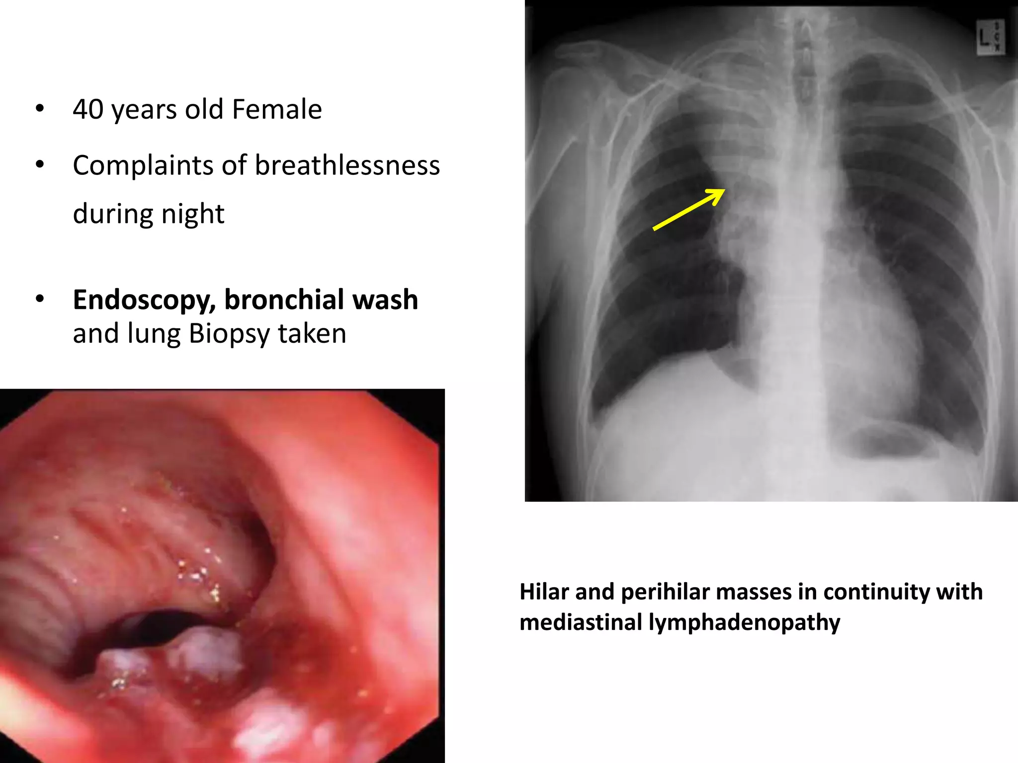 • 40 years old Female
• Complaints of breathlessness
during night
• Endoscopy, bronchial wash
and lung Biopsy taken
Hilar and perihilar masses in continuity with
mediastinal lymphadenopathy
 