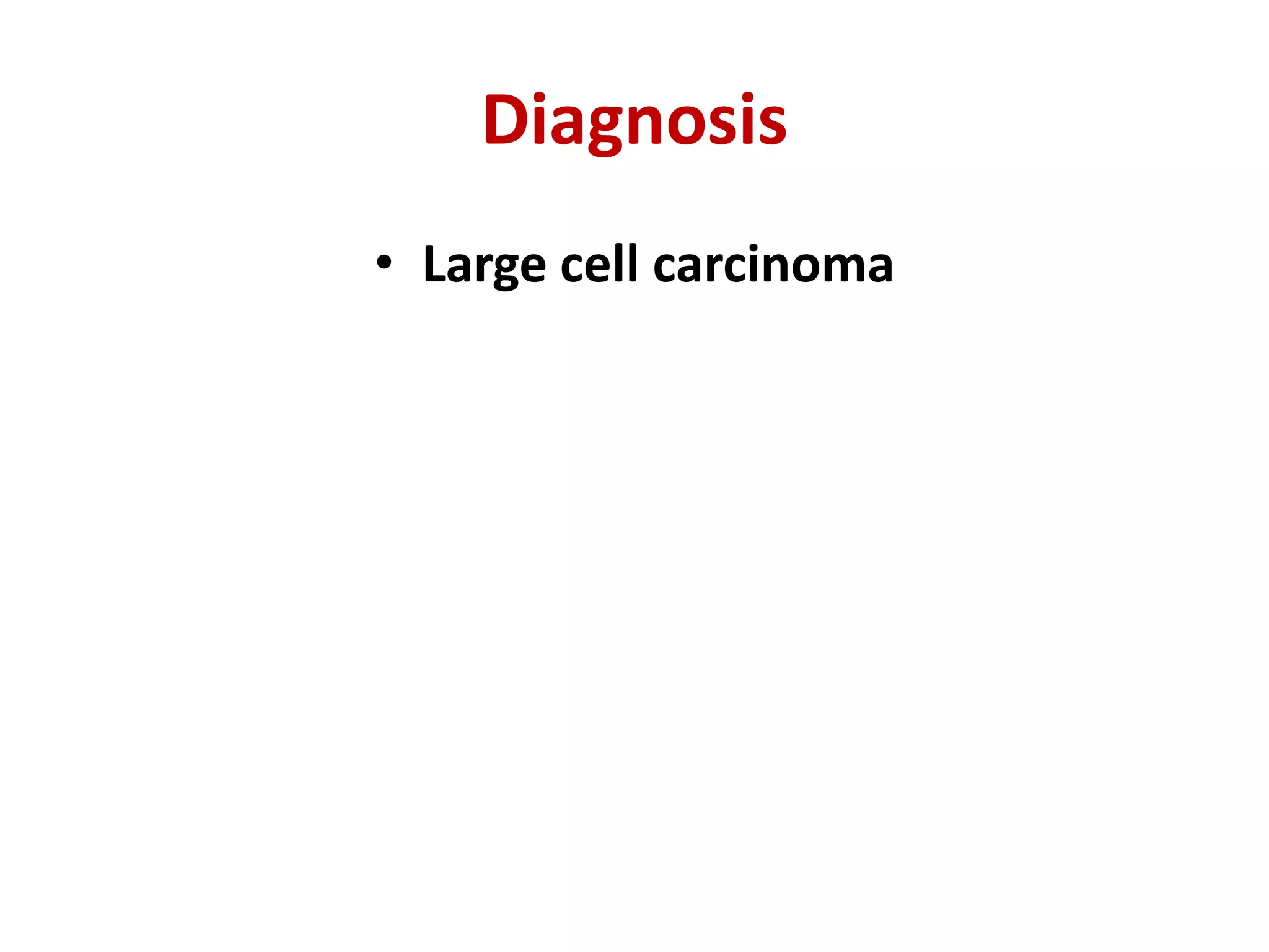 Diagnosis
• Large cell carcinoma
 