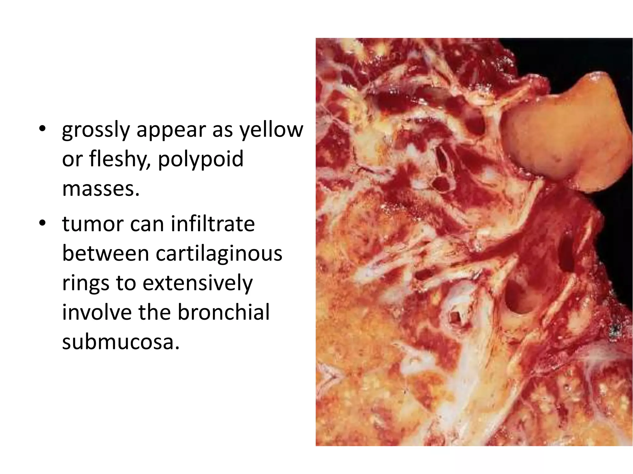 • grossly appear as yellow
or fleshy, polypoid
masses.
• tumor can infiltrate
between cartilaginous
rings to extensively
involve the bronchial
submucosa.
 