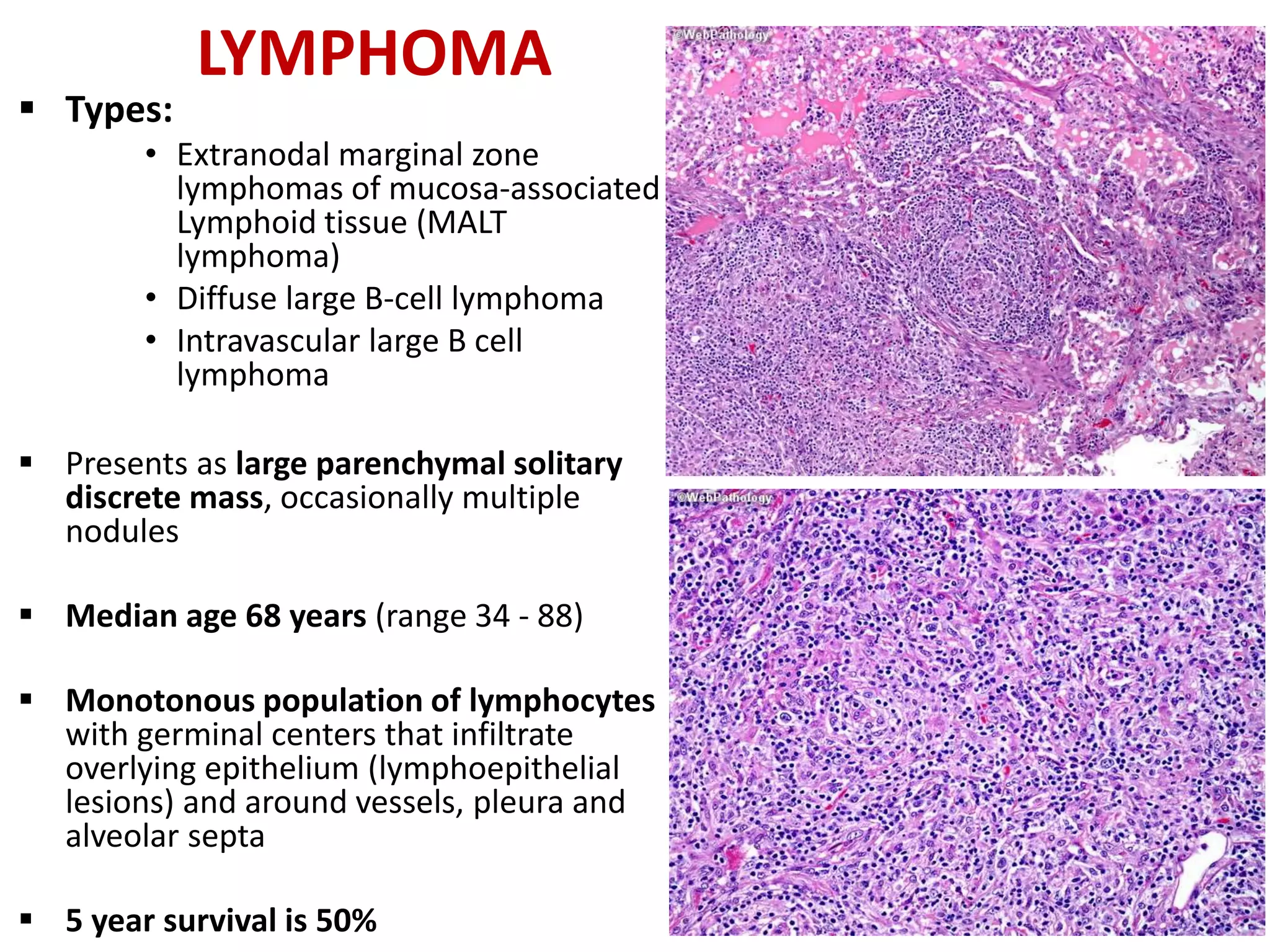 LYMPHOMA
 Types:
• Extranodal marginal zone
lymphomas of mucosa-associated
Lymphoid tissue (MALT
lymphoma)
• Diffuse large B-cell lymphoma
• Intravascular large B cell
lymphoma
 Presents as large parenchymal solitary
discrete mass, occasionally multiple
nodules
 Median age 68 years (range 34 - 88)
 Monotonous population of lymphocytes
with germinal centers that infiltrate
overlying epithelium (lymphoepithelial
lesions) and around vessels, pleura and
alveolar septa
 5 year survival is 50%
 