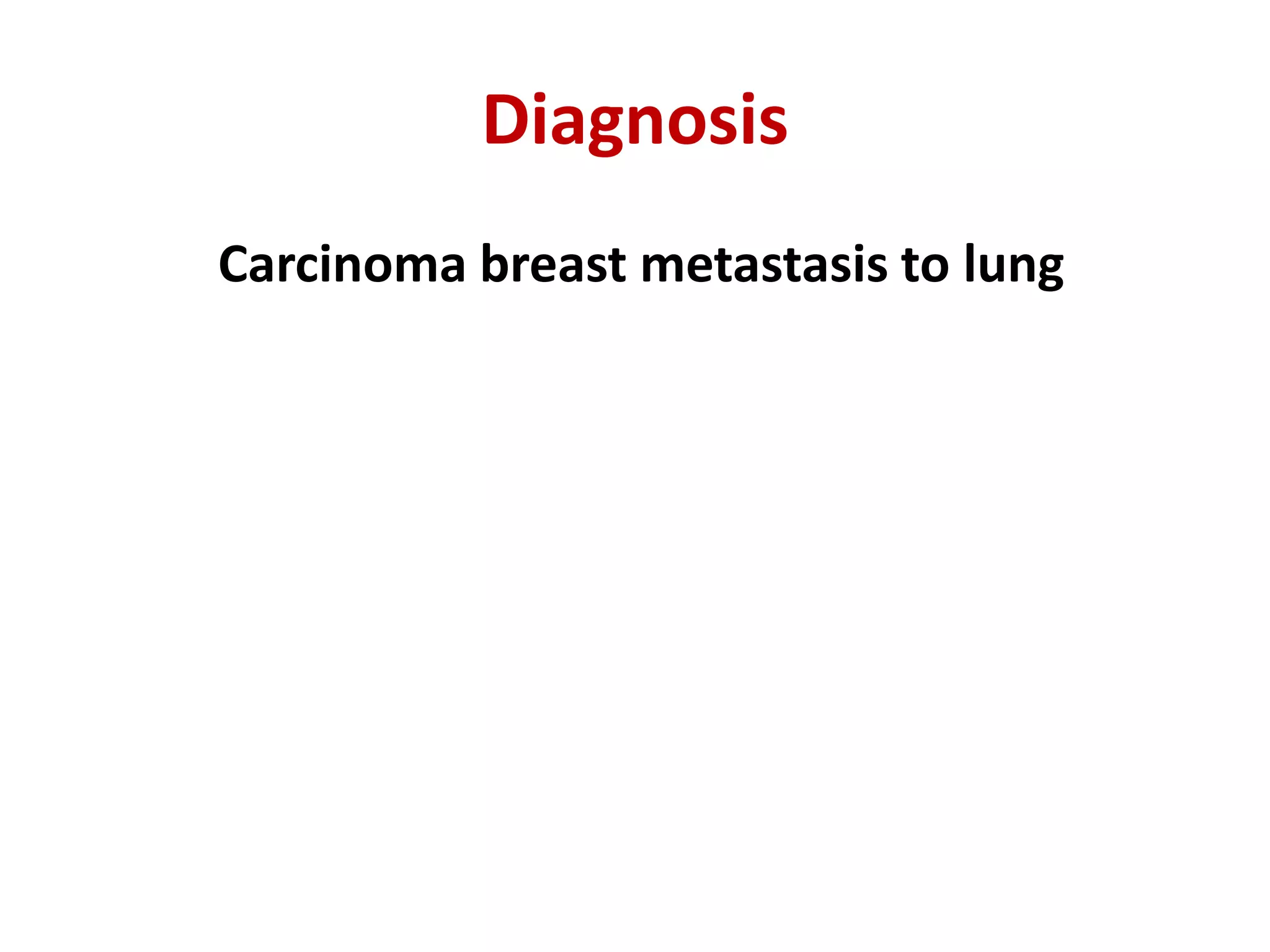 Diagnosis
Carcinoma breast metastasis to lung
 