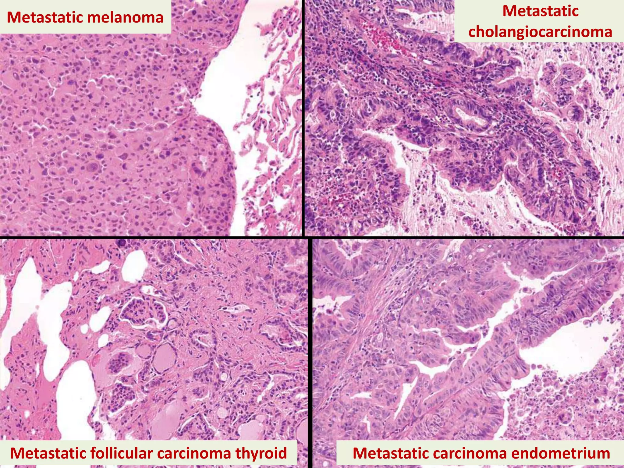 Metastatic melanoma
Metastatic follicular carcinoma thyroid
Metastatic
cholangiocarcinoma
Metastatic carcinoma endometrium
 