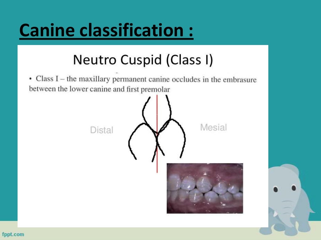 Classification of malocclusion in orthodontics