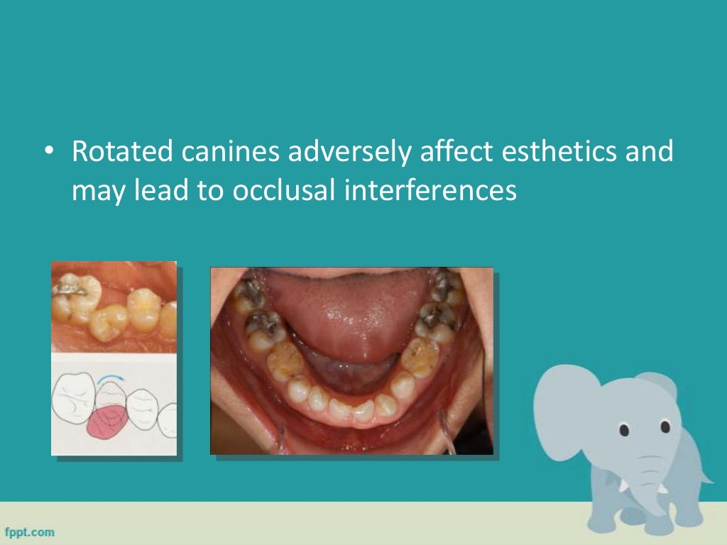 Classification of malocclusion in orthodontics