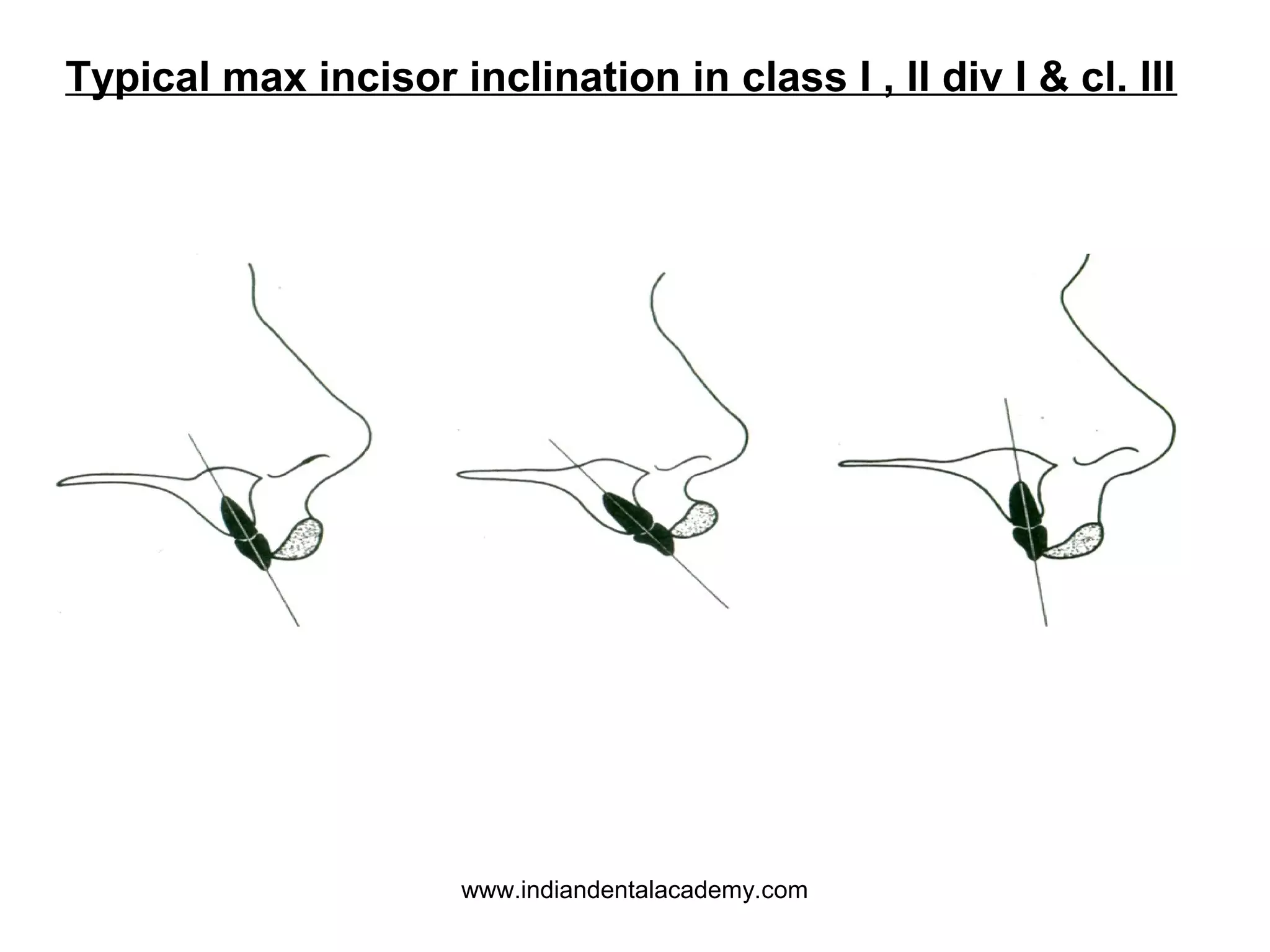 Typical max incisor inclination in class I , II div I & cl. III

www.indiandentalacademy.com

 