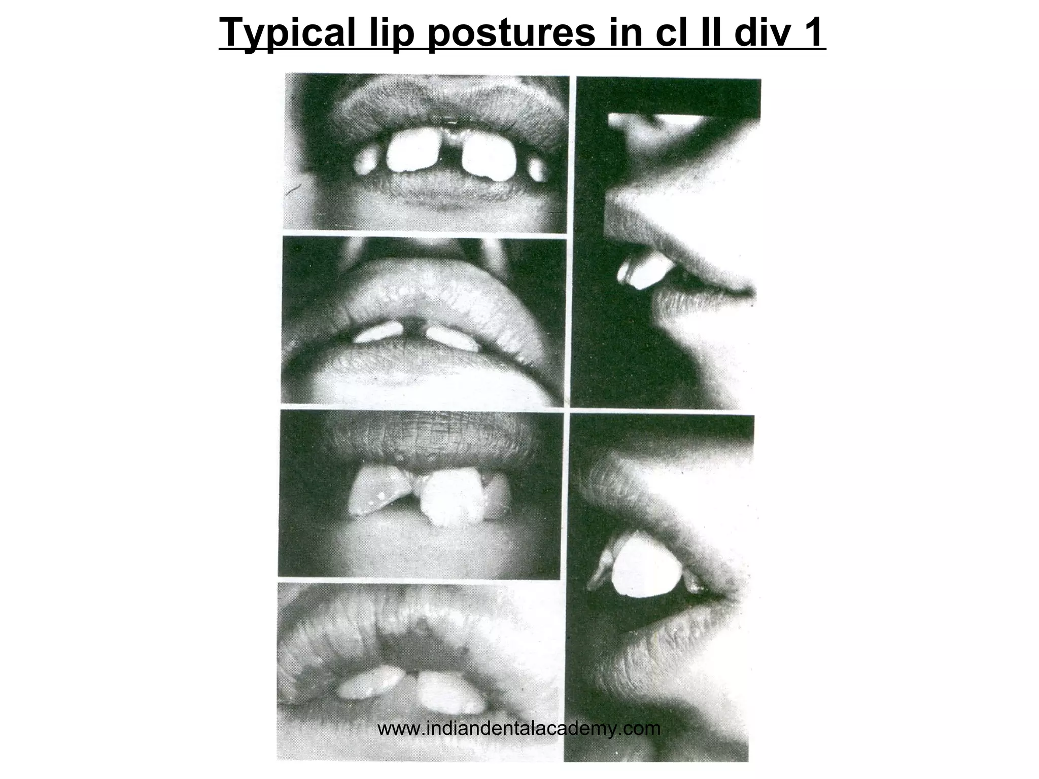 Typical lip postures in cl II div 1

www.indiandentalacademy.com

 