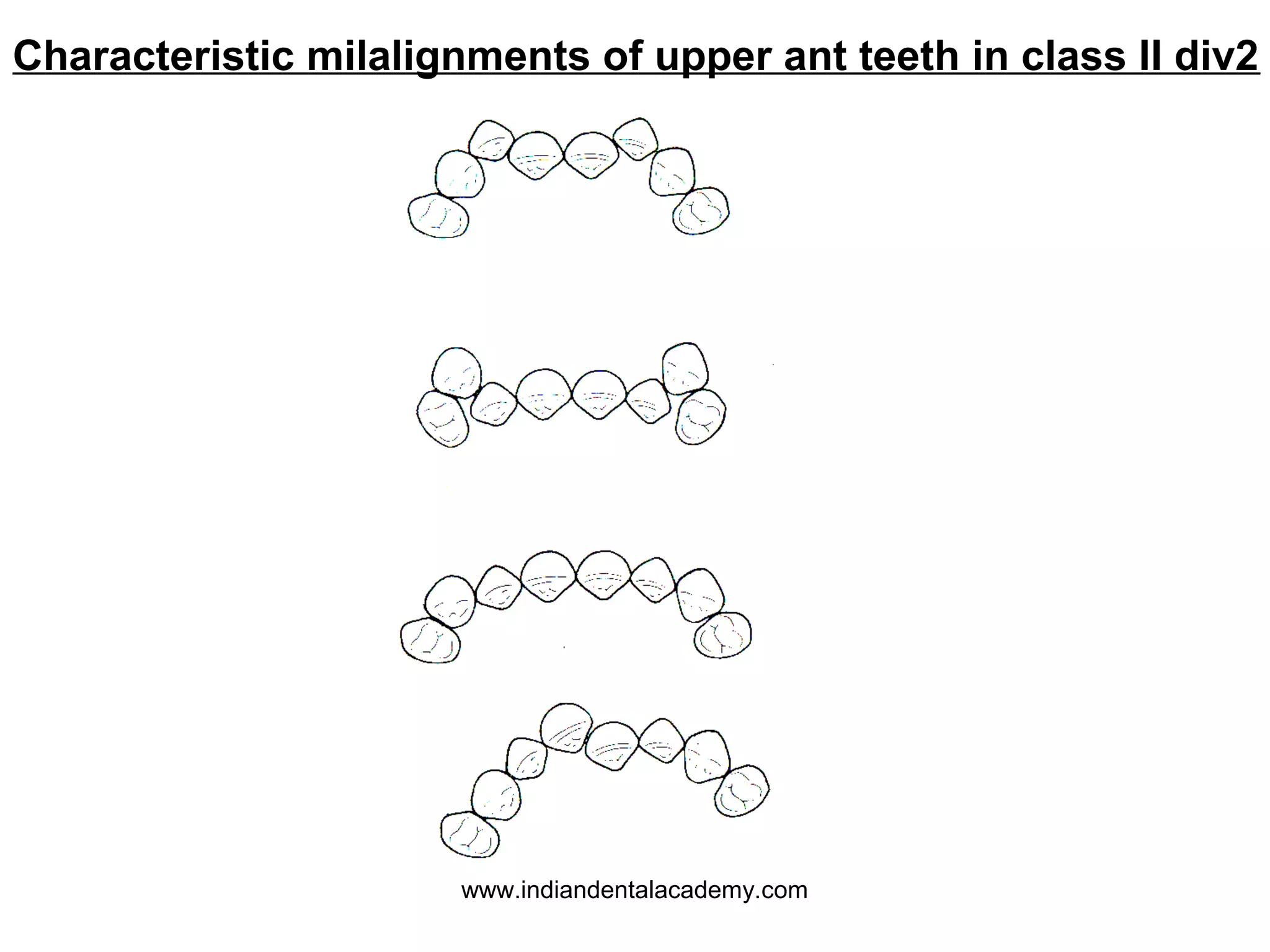 Characteristic milalignments of upper ant teeth in class II div2

www.indiandentalacademy.com

 