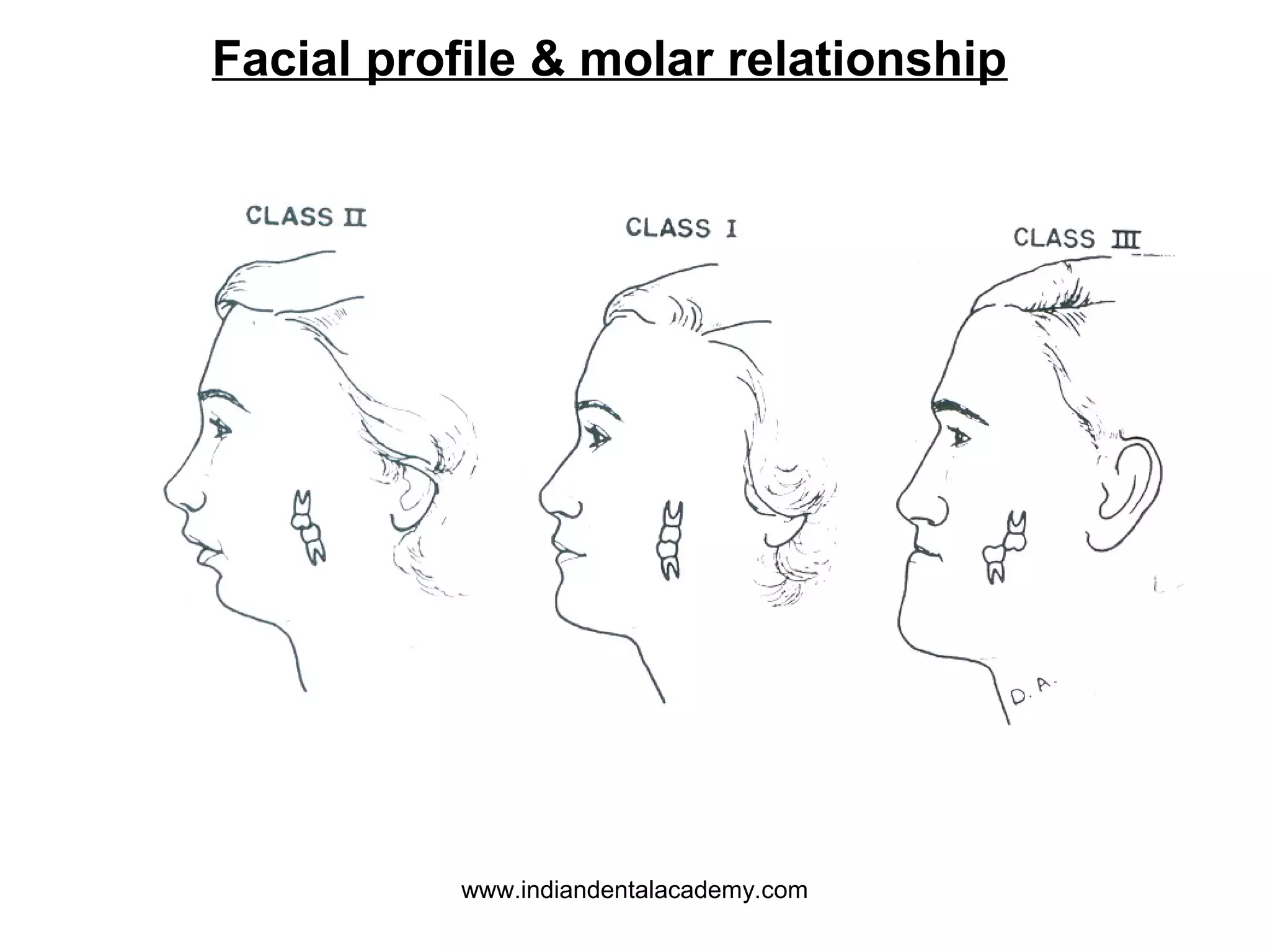 Facial profile & molar relationship

www.indiandentalacademy.com

 