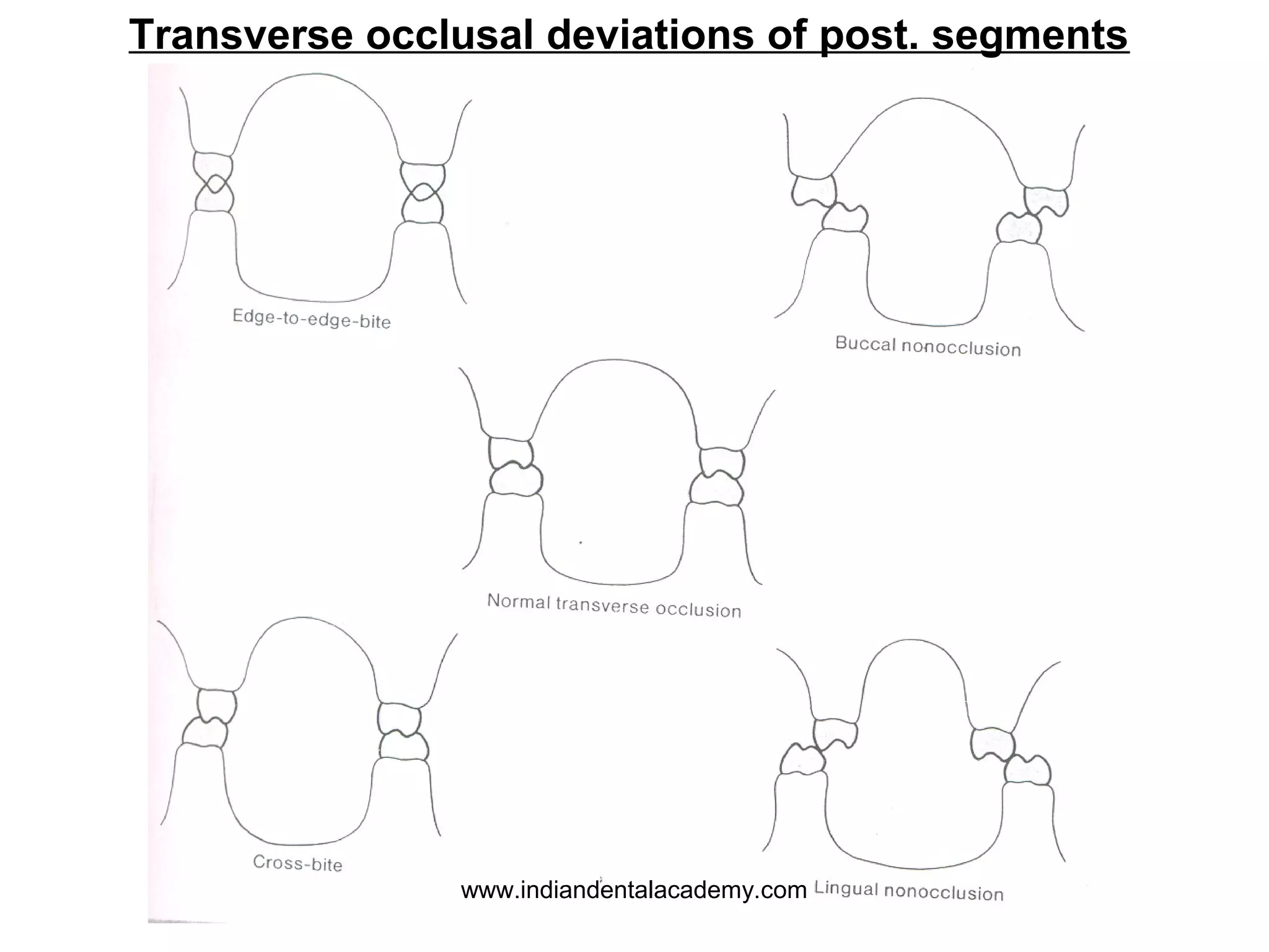 Transverse occlusal deviations of post. segments

www.indiandentalacademy.com

 