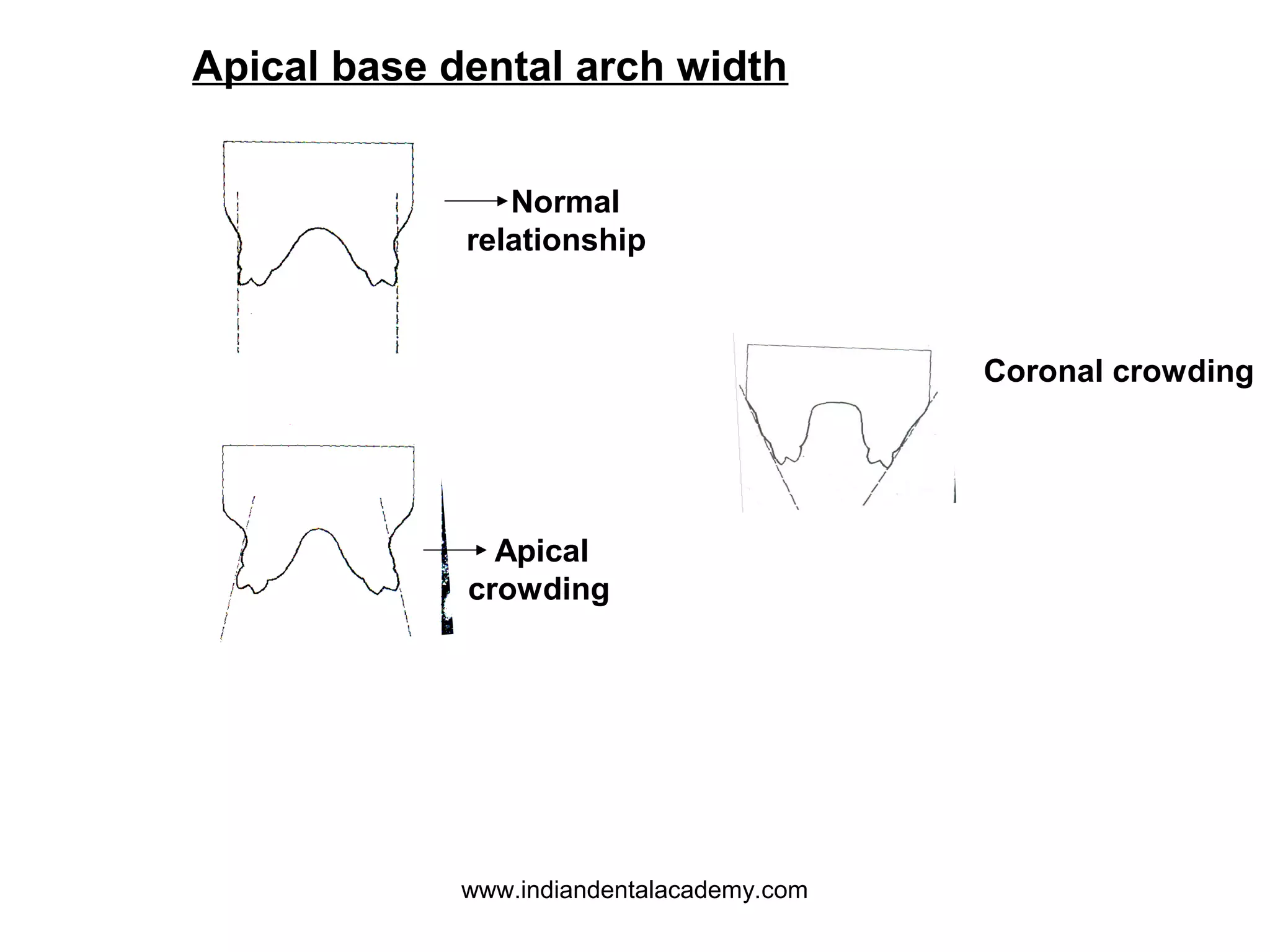 Apical base dental arch width
Normal
relationship

Coronal crowding

Apical
crowding

www.indiandentalacademy.com

 