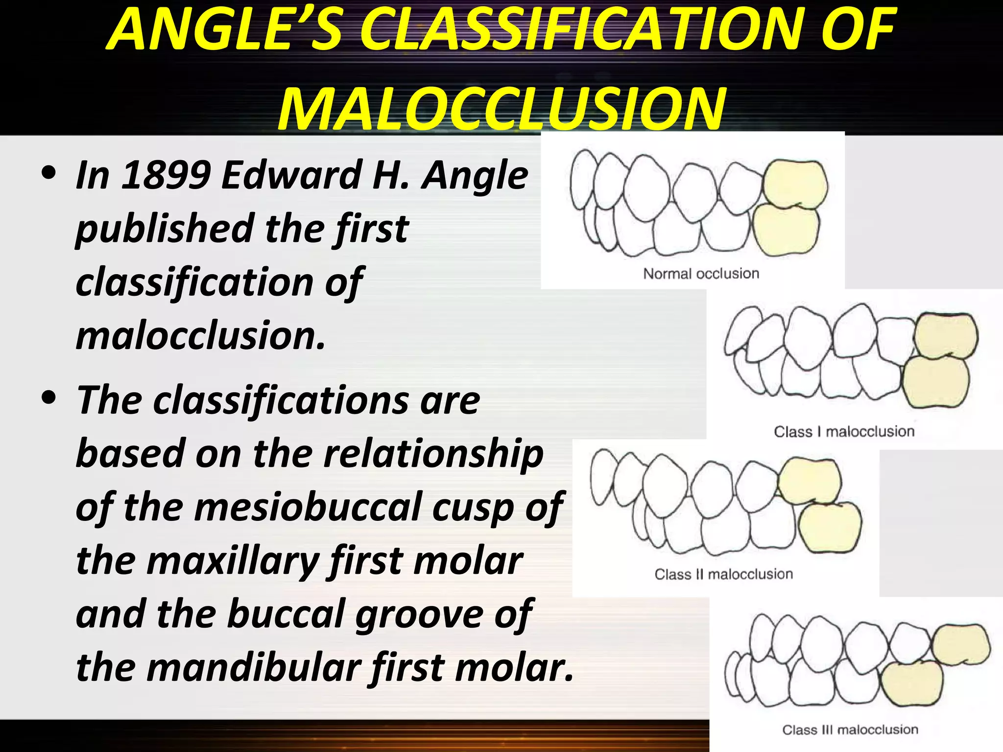 ANGLE’S CLASSIFICATION OF
MALOCCLUSION

• In 1899 Edward H. Angle
published the first
classification of
malocclusion.
• The classifications are
based on the relationship
of the mesiobuccal cusp of
the maxillary first molar
and the buccal groove of
the mandibular first molar.

 