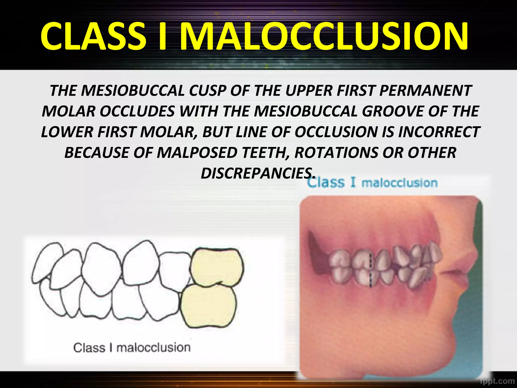 CLASS I MALOCCLUSION
THE MESIOBUCCAL CUSP OF THE UPPER FIRST PERMANENT
MOLAR OCCLUDES WITH THE MESIOBUCCAL GROOVE OF THE
LOWER FIRST MOLAR, BUT LINE OF OCCLUSION IS INCORRECT
BECAUSE OF MALPOSED TEETH, ROTATIONS OR OTHER
DISCREPANCIES.

 