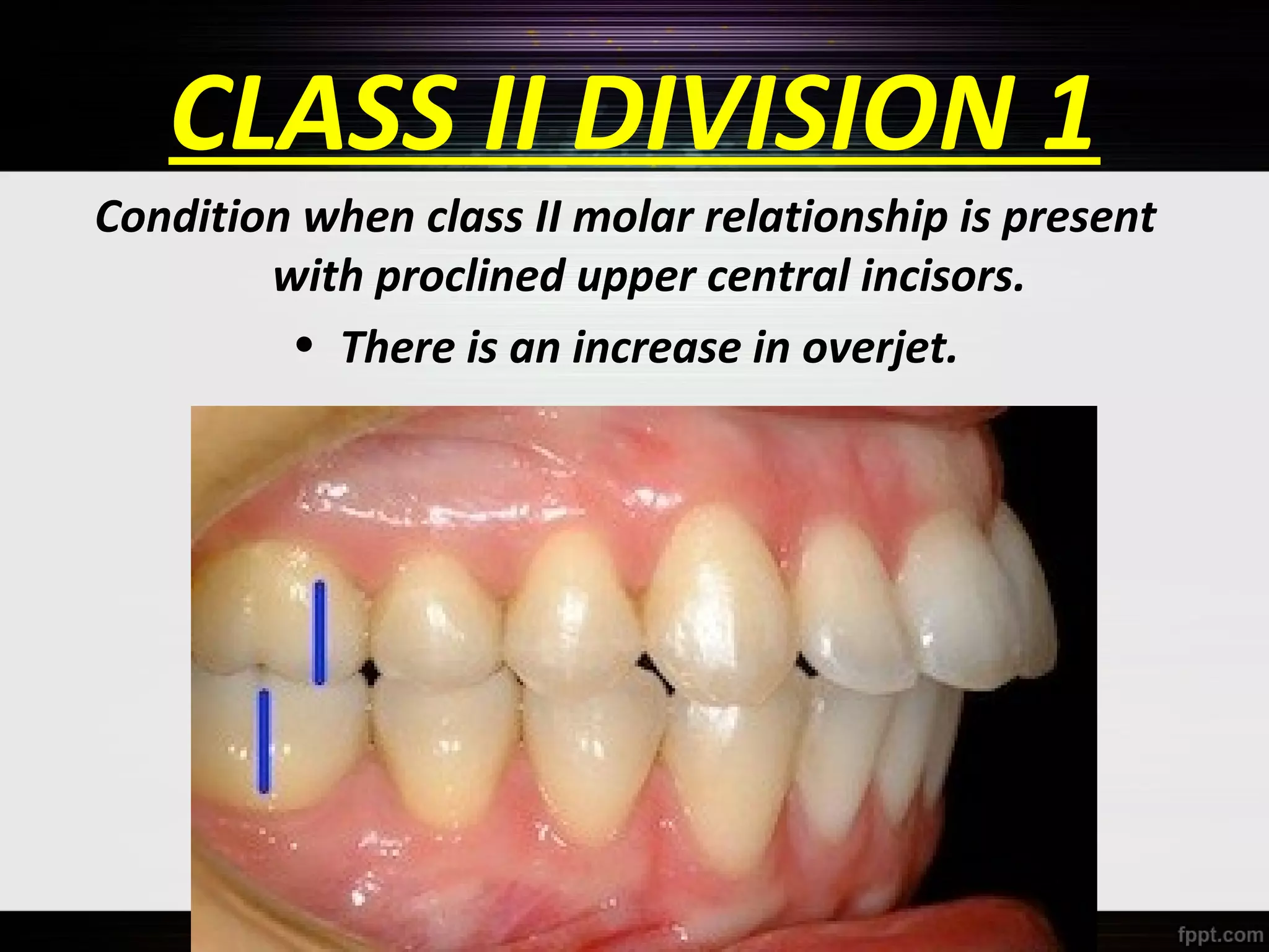 CLASS II DIVISION 1
Condition when class II molar relationship is present
with proclined upper central incisors.
• There is an increase in overjet.

 