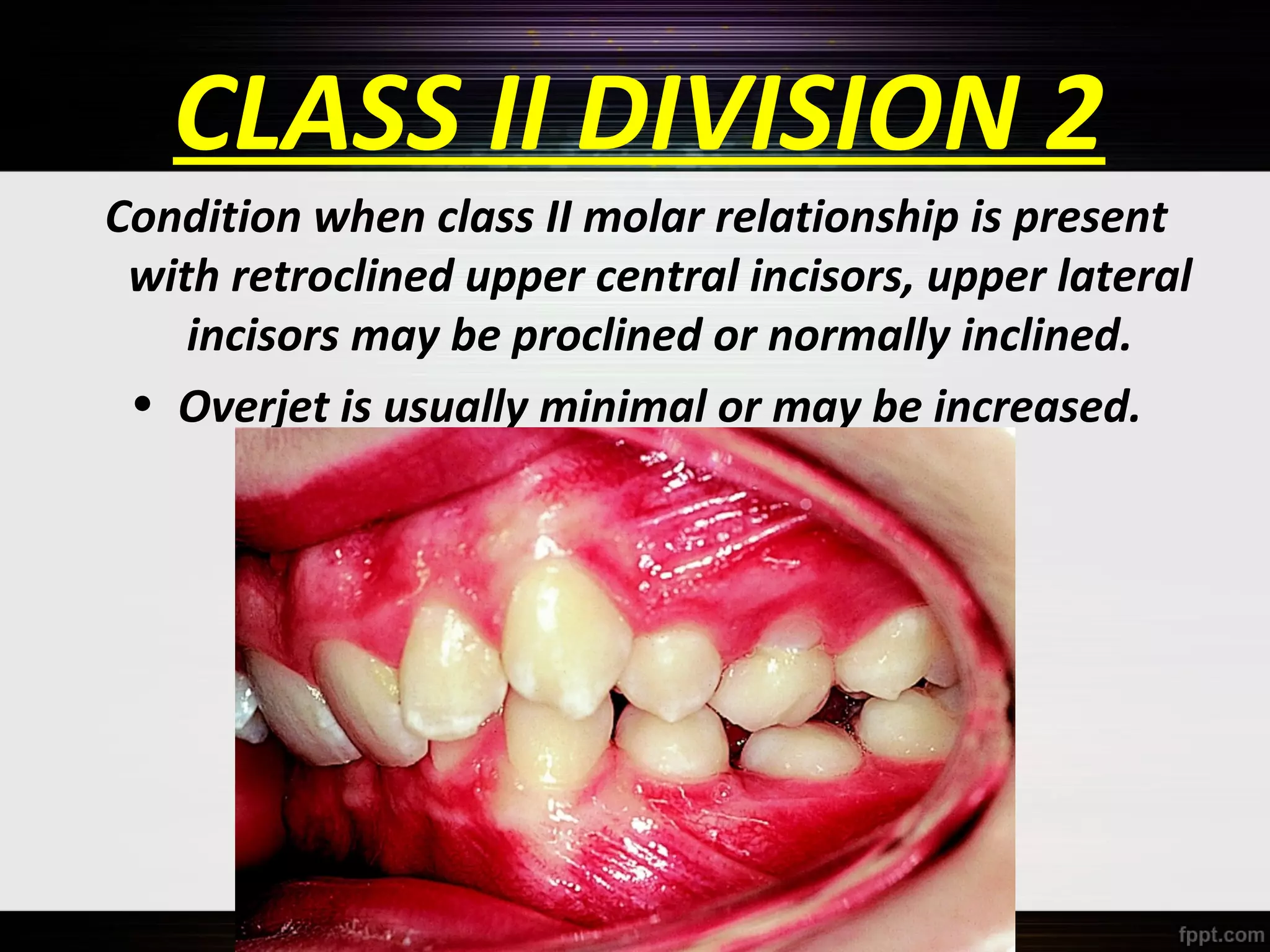 CLASS II DIVISION 2
Condition when class II molar relationship is present
with retroclined upper central incisors, upper lateral
incisors may be proclined or normally inclined.
• Overjet is usually minimal or may be increased.

 