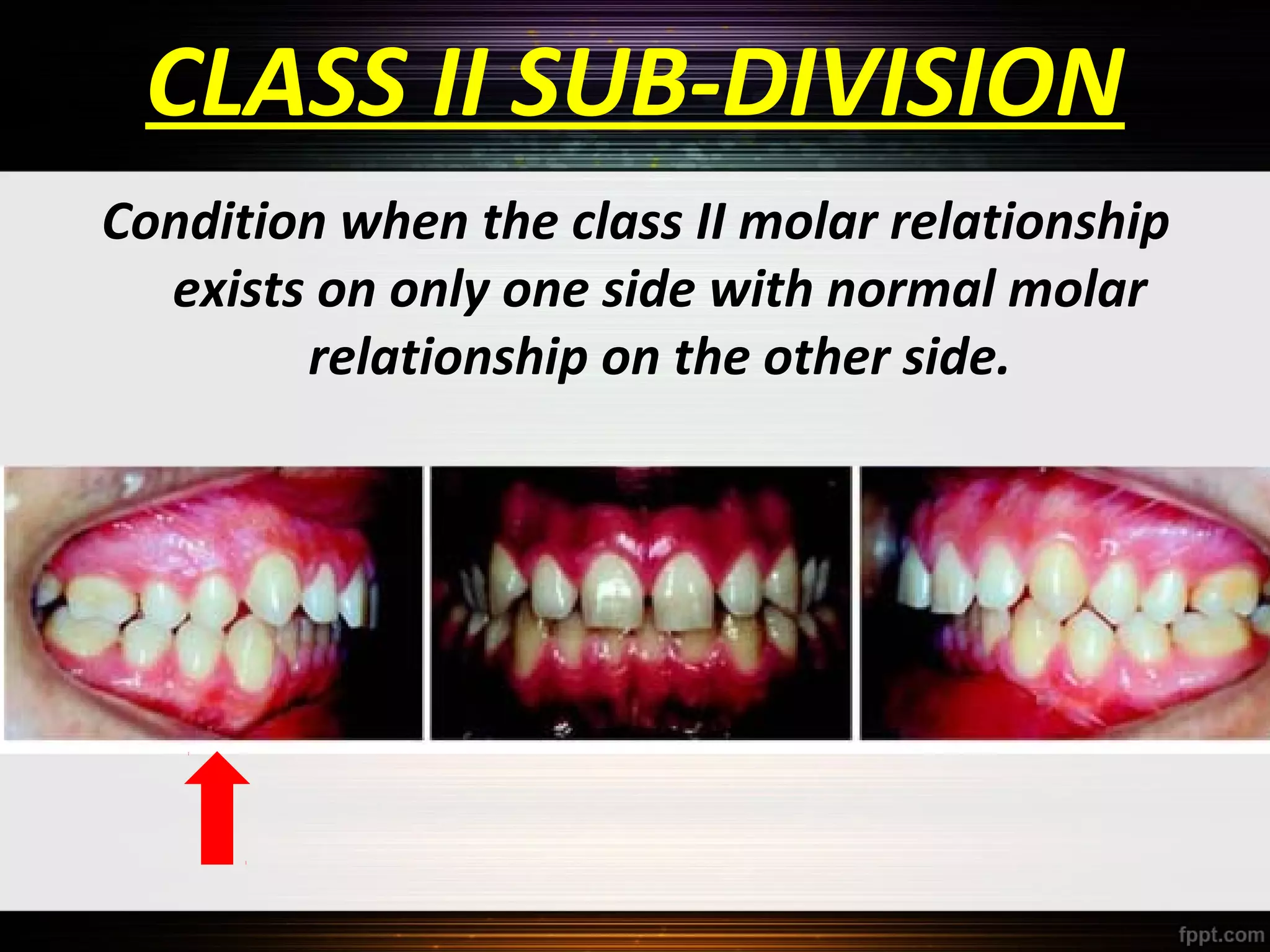 CLASS II SUB-DIVISION
Condition when the class II molar relationship
exists on only one side with normal molar
relationship on the other side.

 