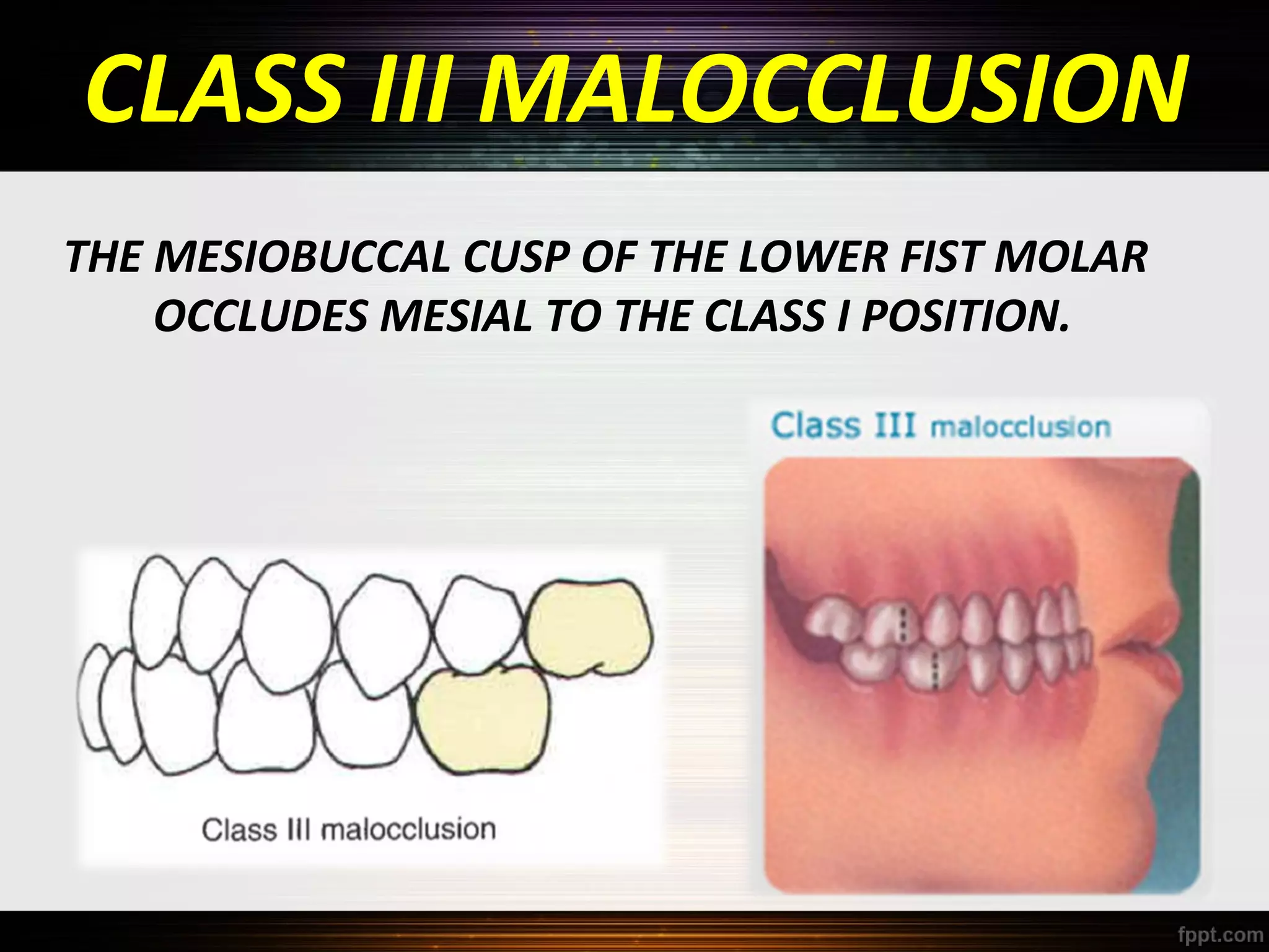 CLASS III MALOCCLUSION
THE MESIOBUCCAL CUSP OF THE LOWER FIST MOLAR
OCCLUDES MESIAL TO THE CLASS I POSITION.

 