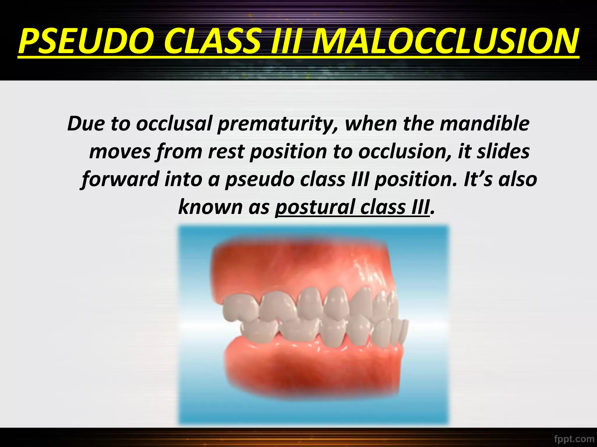 PSEUDO CLASS III MALOCCLUSION
Due to occlusal prematurity, when the mandible
moves from rest position to occlusion, it slides
forward into a pseudo class III position. It’s also
known as postural class III.

 
